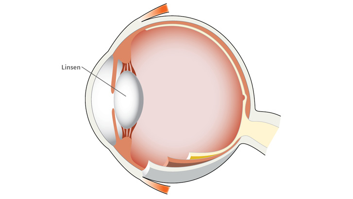 Linsen tilpasser øyets fokus på nært hold.