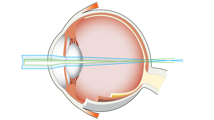 Ved skjeve hornhinner (brytningsfeil) blir lysstrålene spredt ut og treffer netthinnen over et større område.