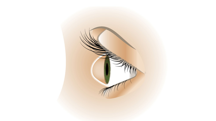 Keratokonus gjør at hornhinnen får en toppete form.