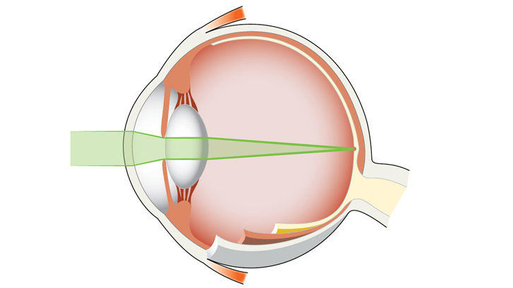 Ved normalt syn bryter lysstrålene til ett punkt på netthinnen.