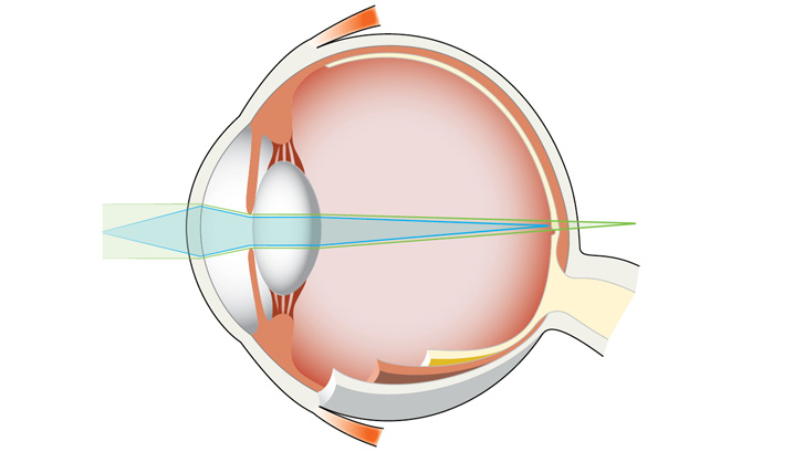 Ved alderssyn har linsen blitt stiv og klarer ikke tilpasse synsskarpheten til objekt på nært hold.