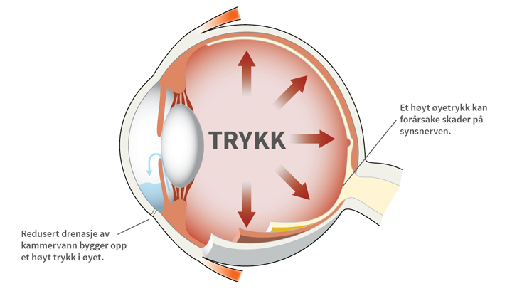 Glaukom oppstår ofte på grunn av at et høyt øyetrykk skaper skader på synsnerven.