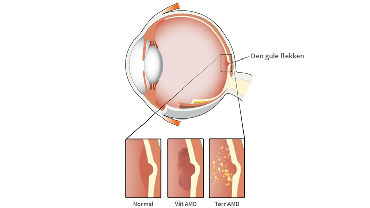 Det finnes to typer forandringer ved aldersrelatert makuladegenerasjon – tørre forandringer og våte forandringer.